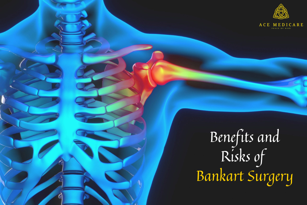 Navigating the Path to Recovery: Understanding the Benefits and Risks of Bankart Surgery for Shoulder Injuries